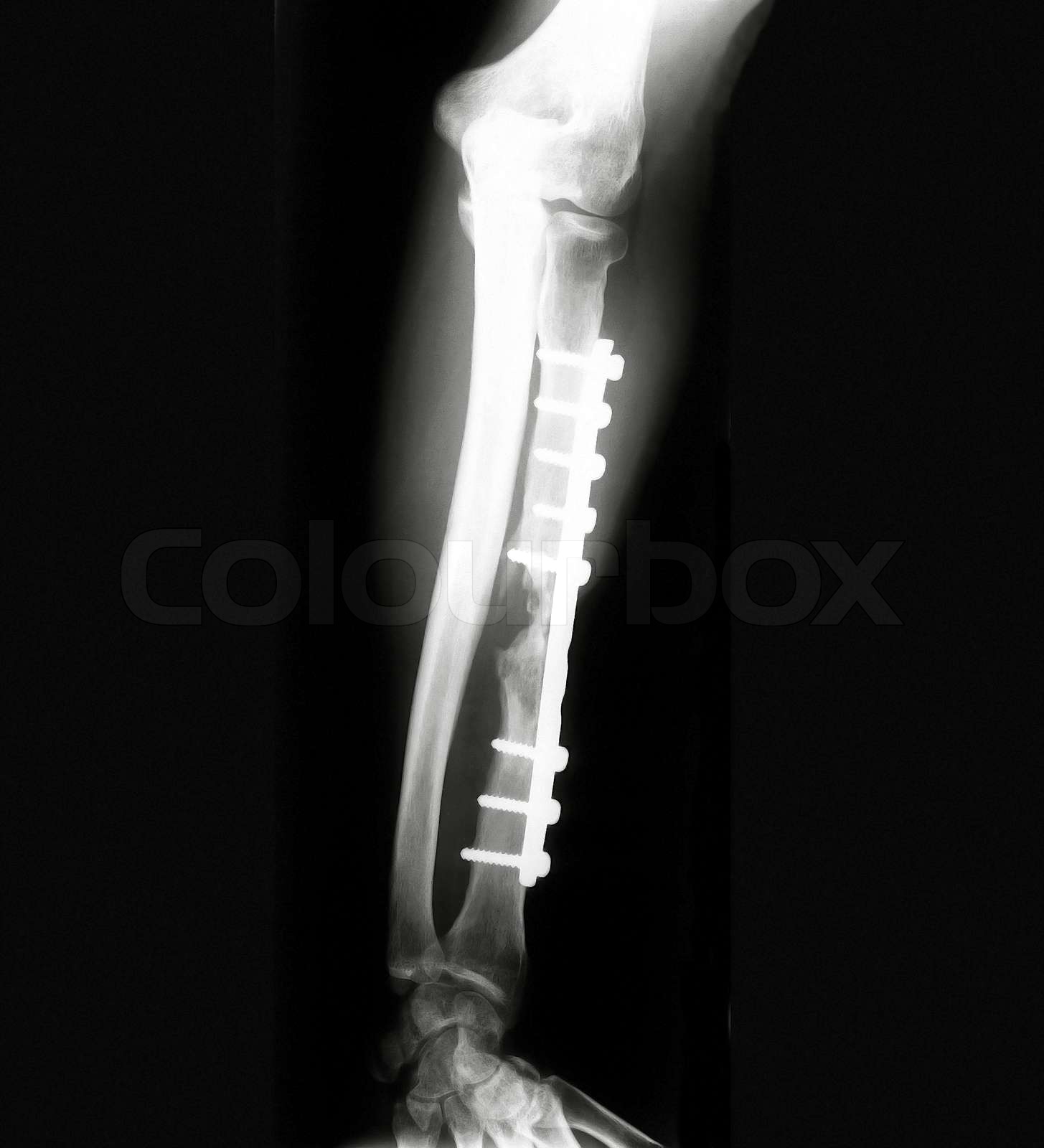 Xray of Forearm Stock image Colourbox