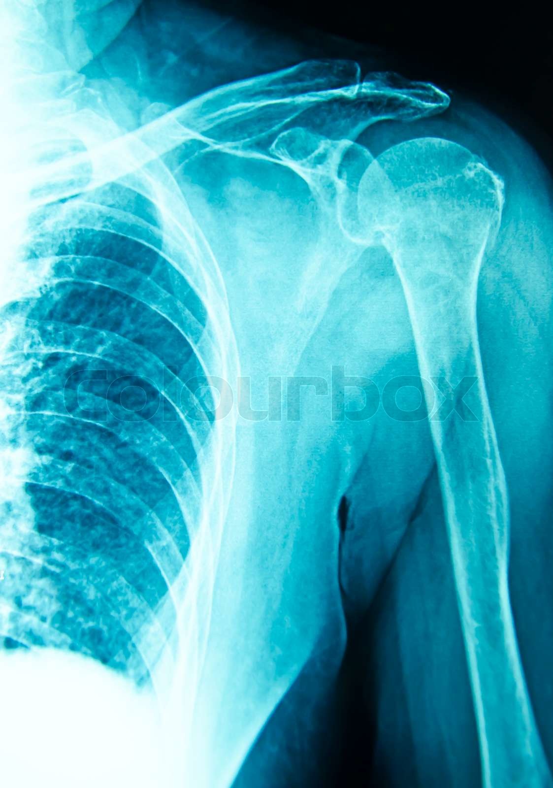 Shoulder xray Stock image Colourbox