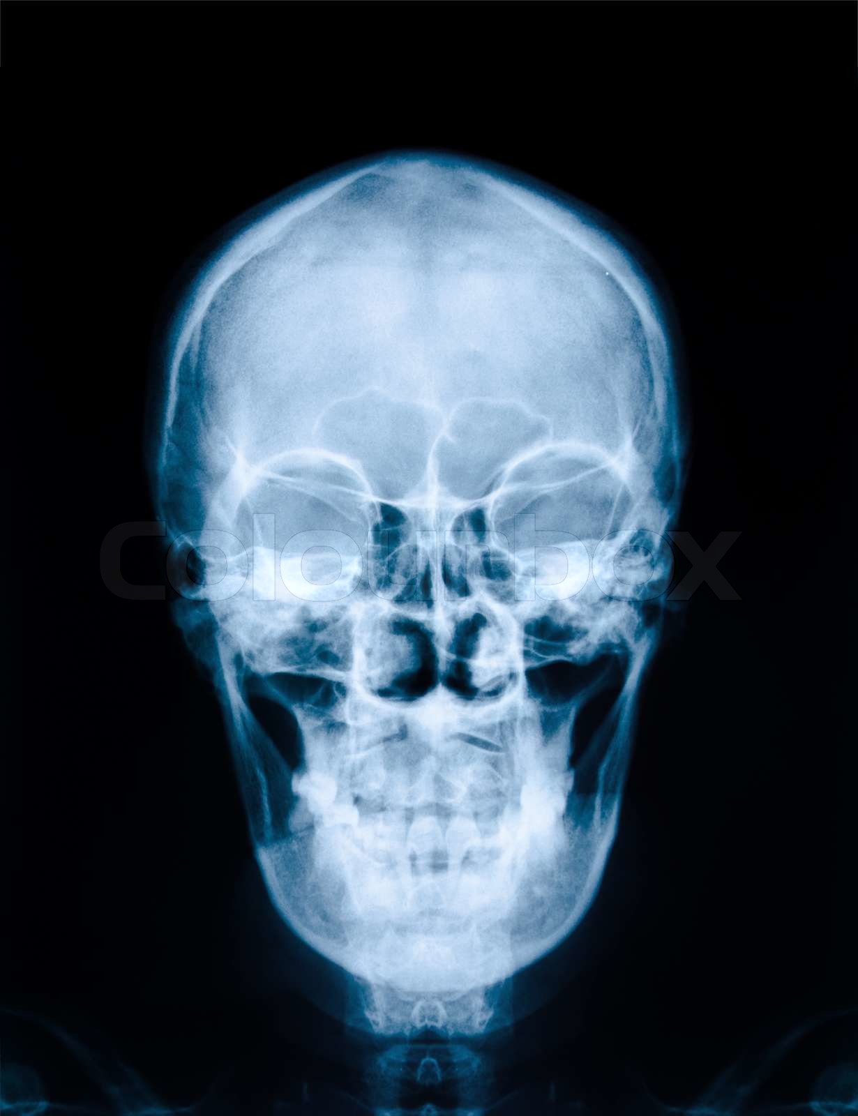 Xray picture of skull Stock image Colourbox