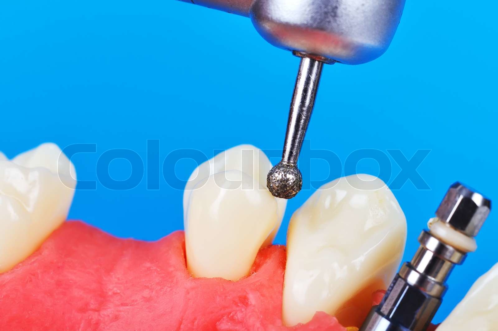 drill and dental implant Stock image Colourbox