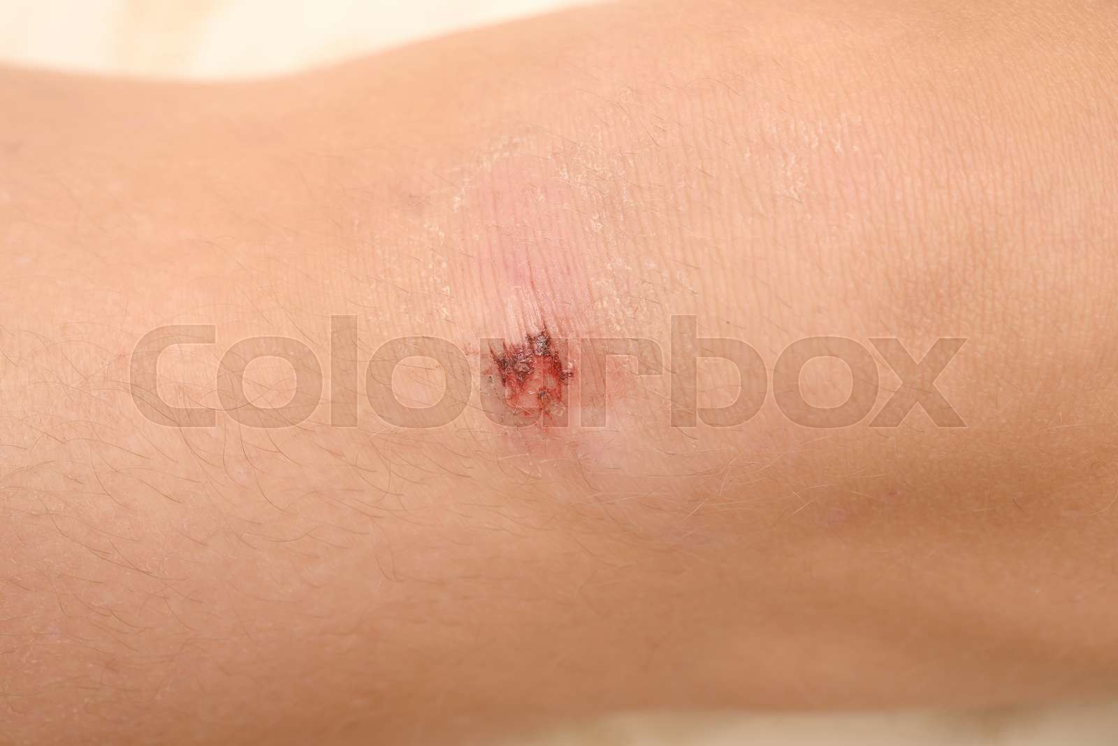 scraped knees Stock image Colourbox