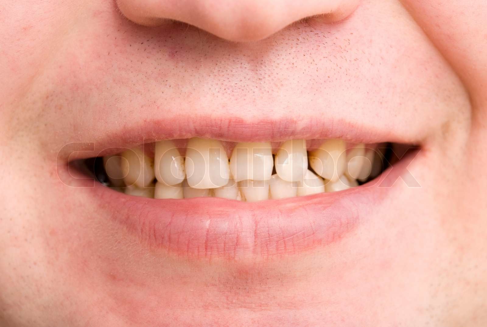 young man with a teeth broken and rotten Stock image Colourbox