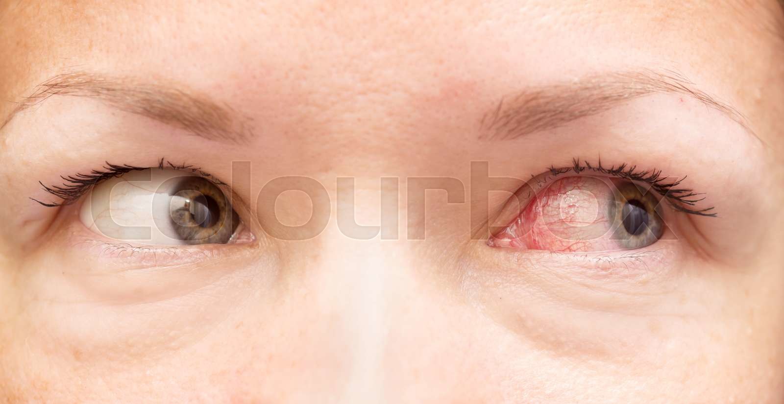 healthy and irritated eye Stock image Colourbox