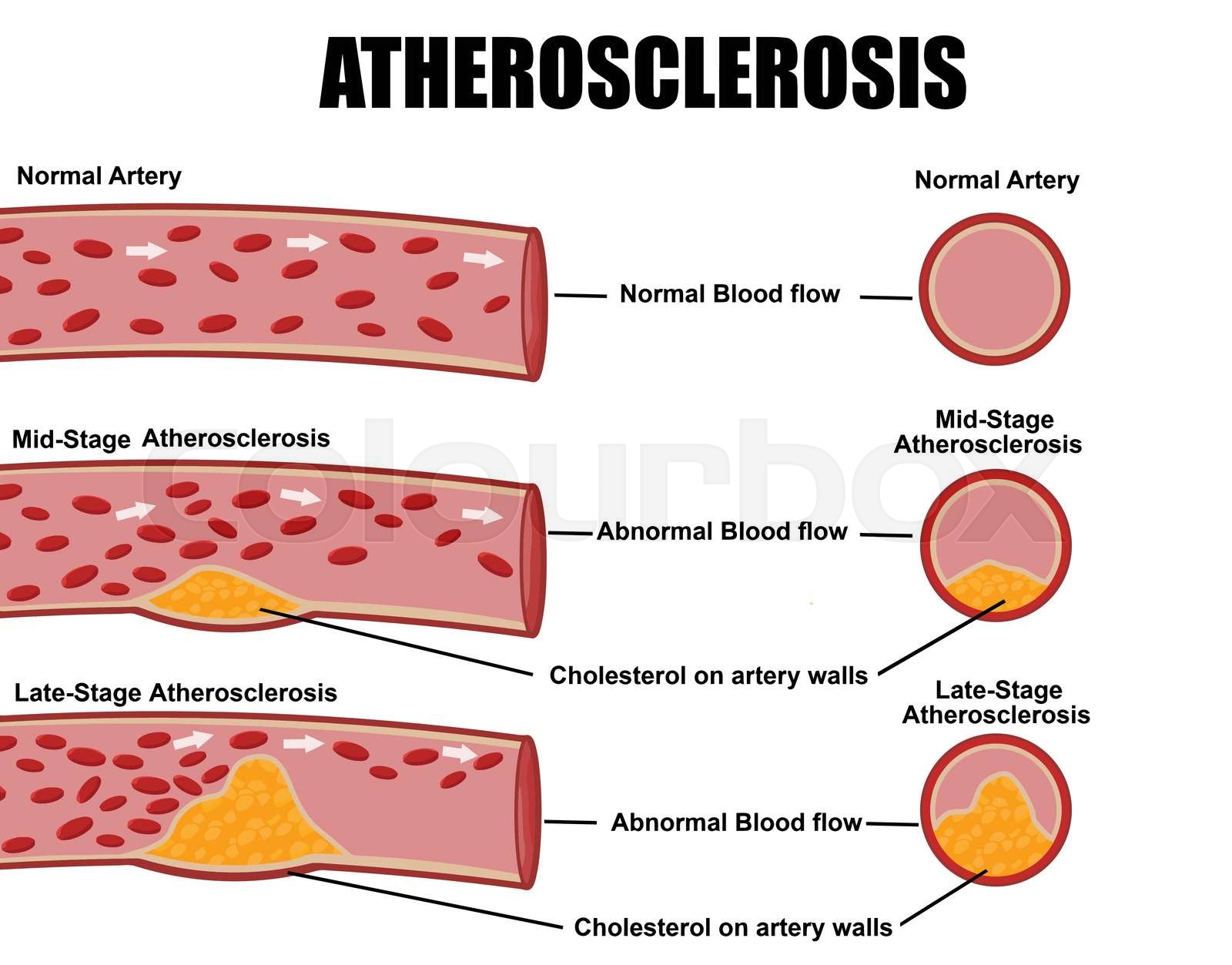 Atherosclerosis Stock Vector Colourbox