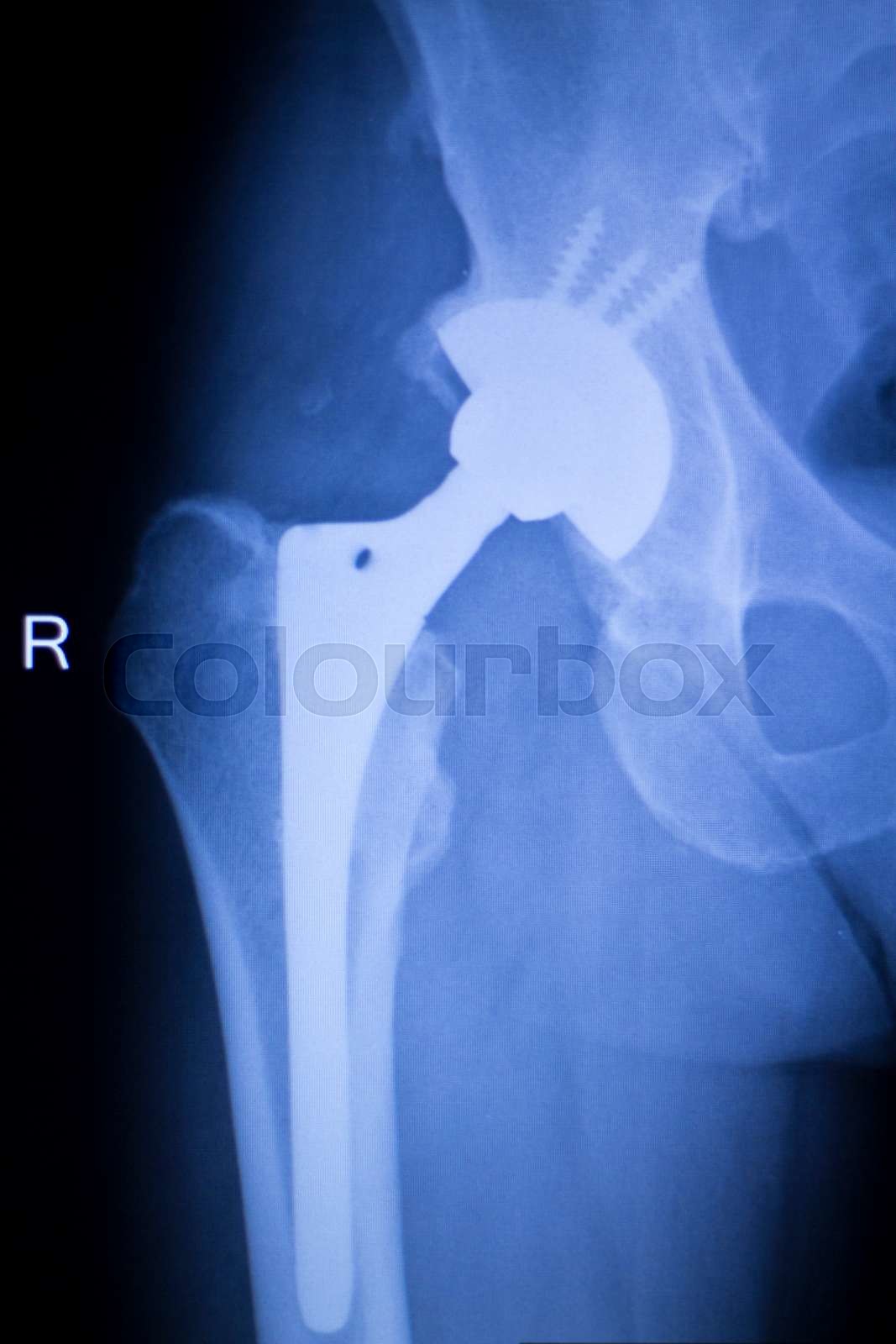 Hip replacement xray orthopedic medical scan Stock image Colourbox