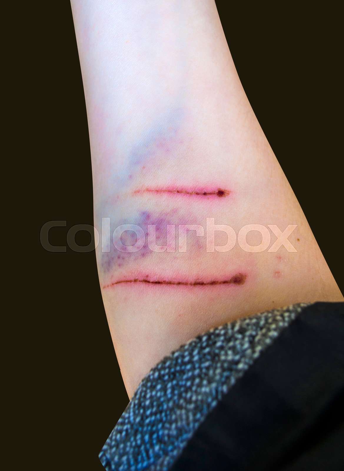 dog bite is. from the dog bite is wound Stock image Colourbox