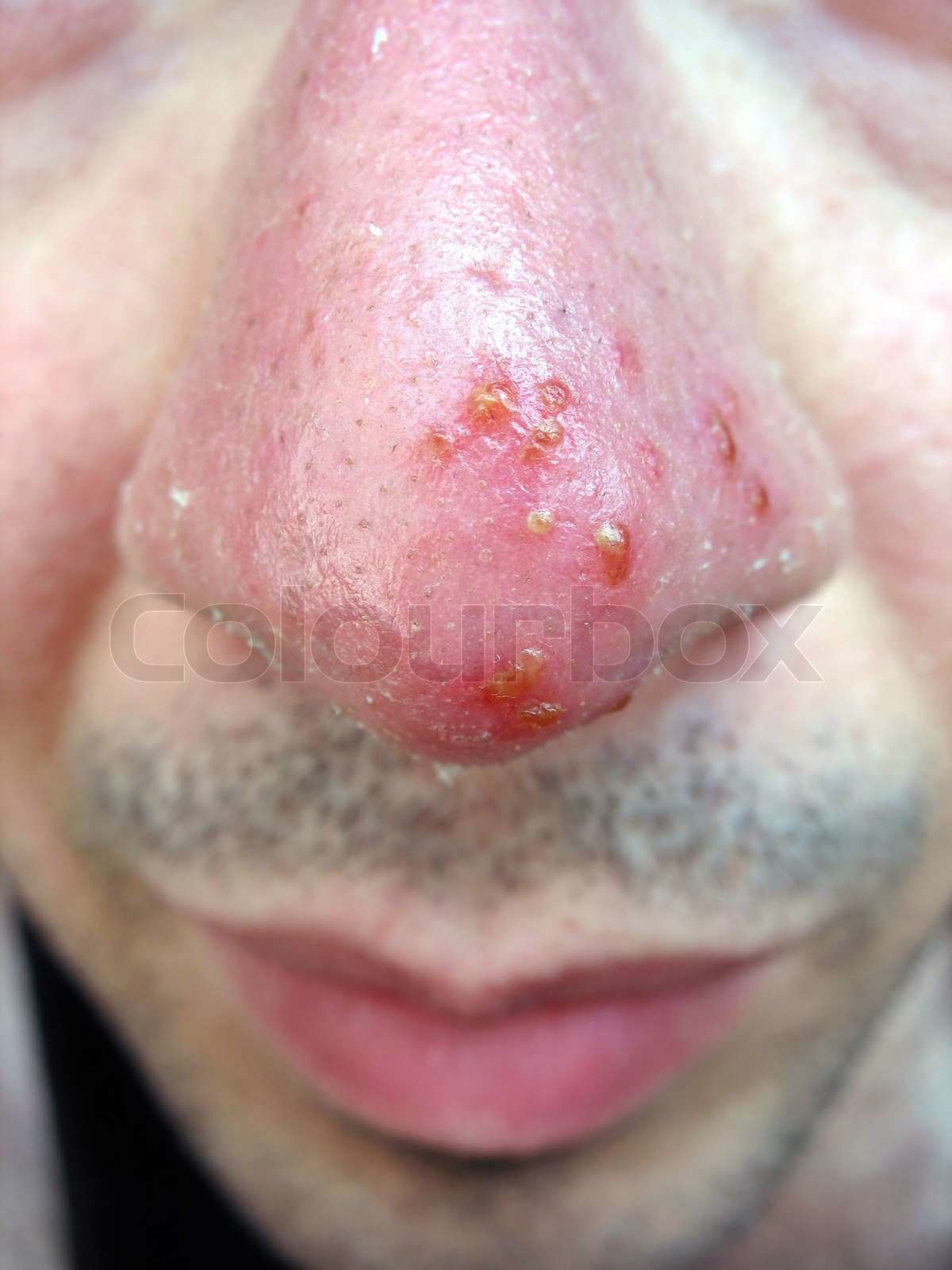 A medical condition closeup of the common coldsore herpes simplex on an