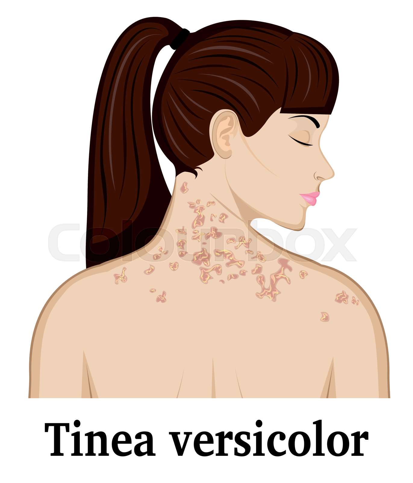 Illustration Of Tinea Versicolor Stock Vector Colourbox Illustration Of Tinea Versicolor Stock Vector Colourbox