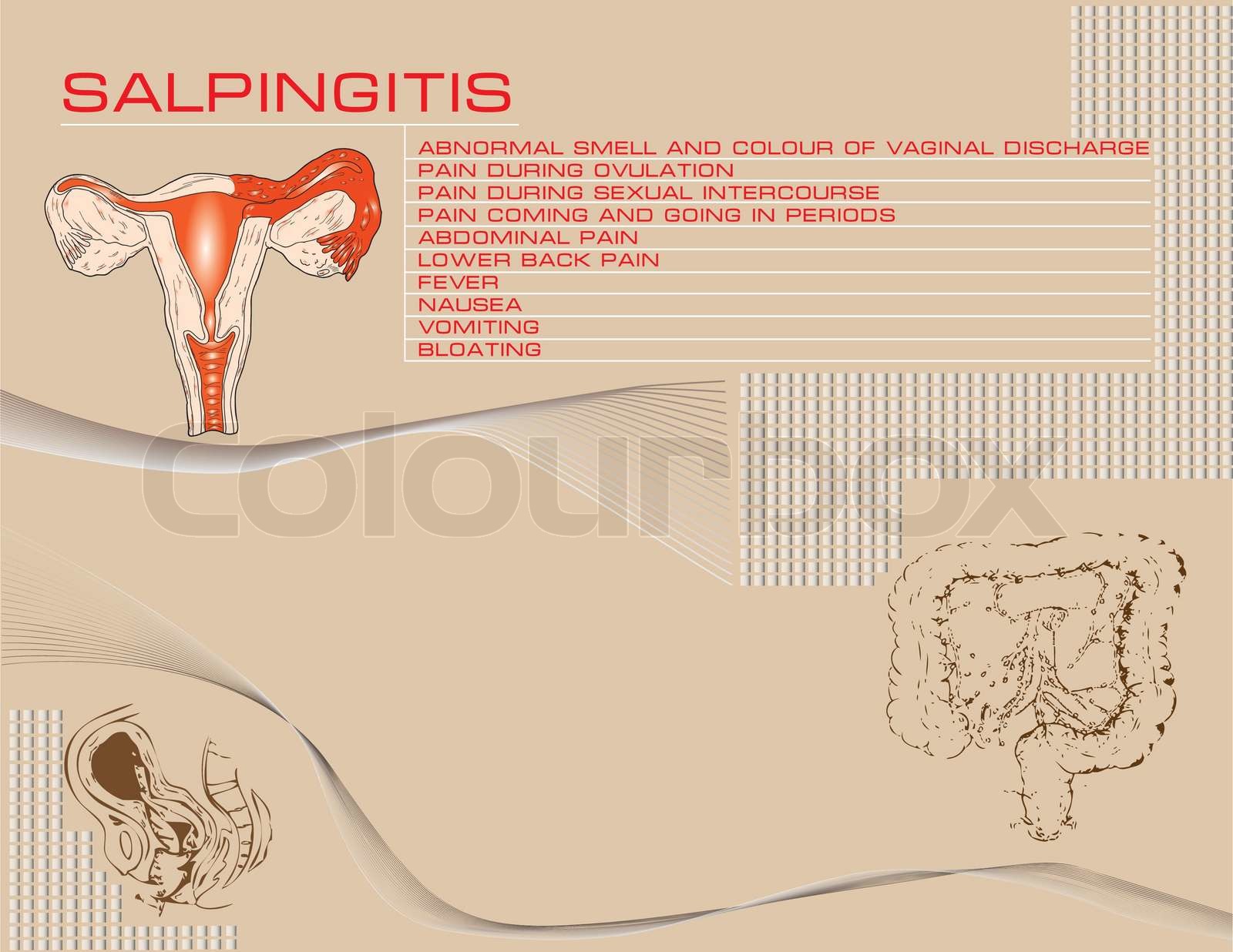Medical Thema Salpingitis Illustration mit Symptomen und eine