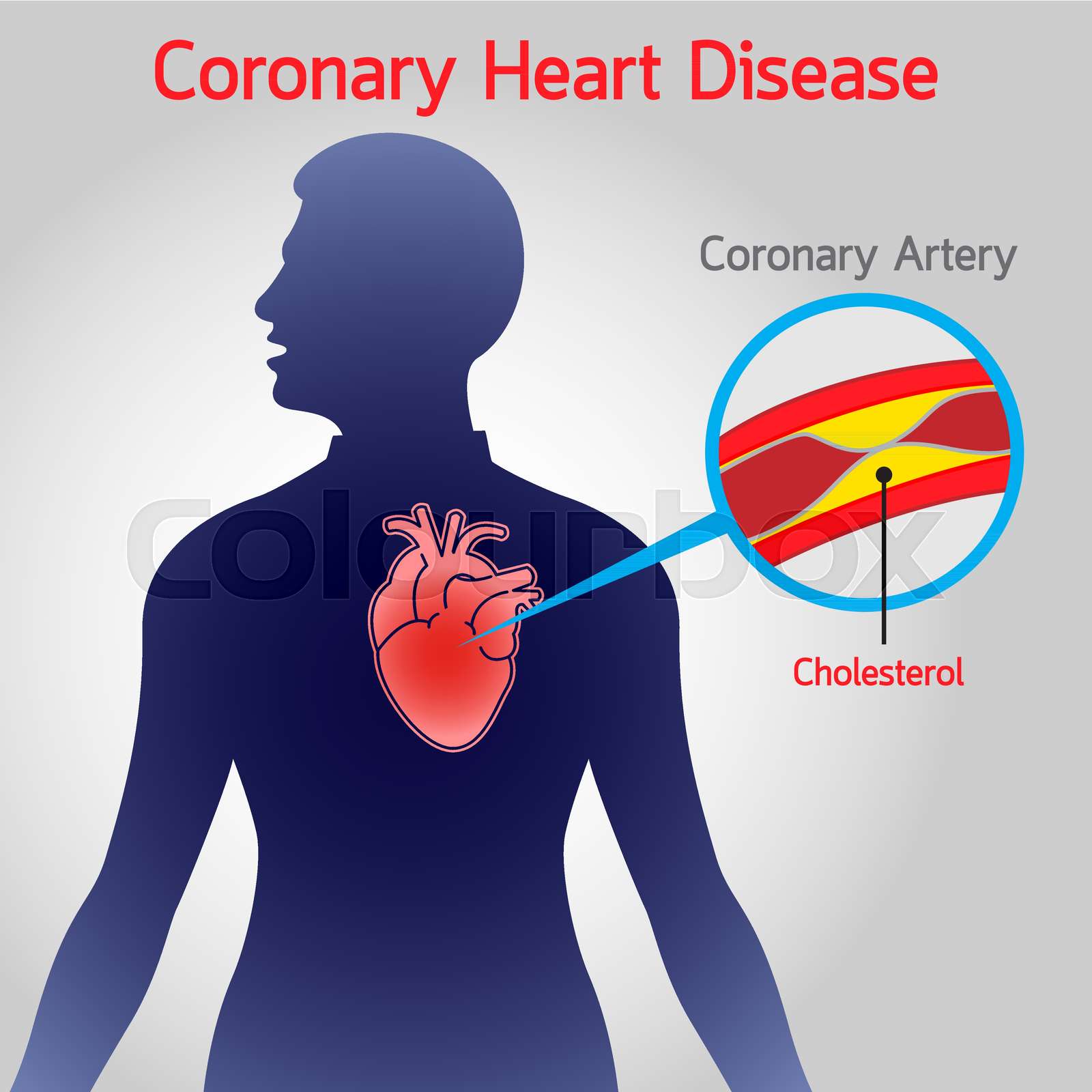 Coronary Heart Disease vector logo icon illustration | Stock vector ...