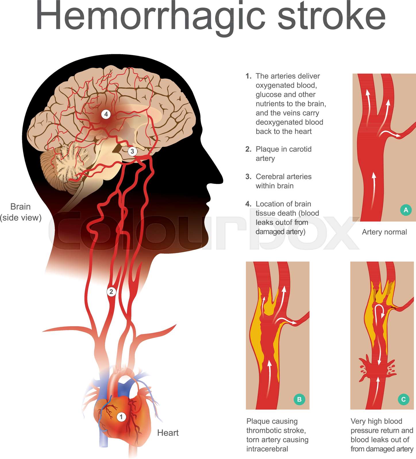 Hemorrhagic Stroke Stock Vector Colourbox