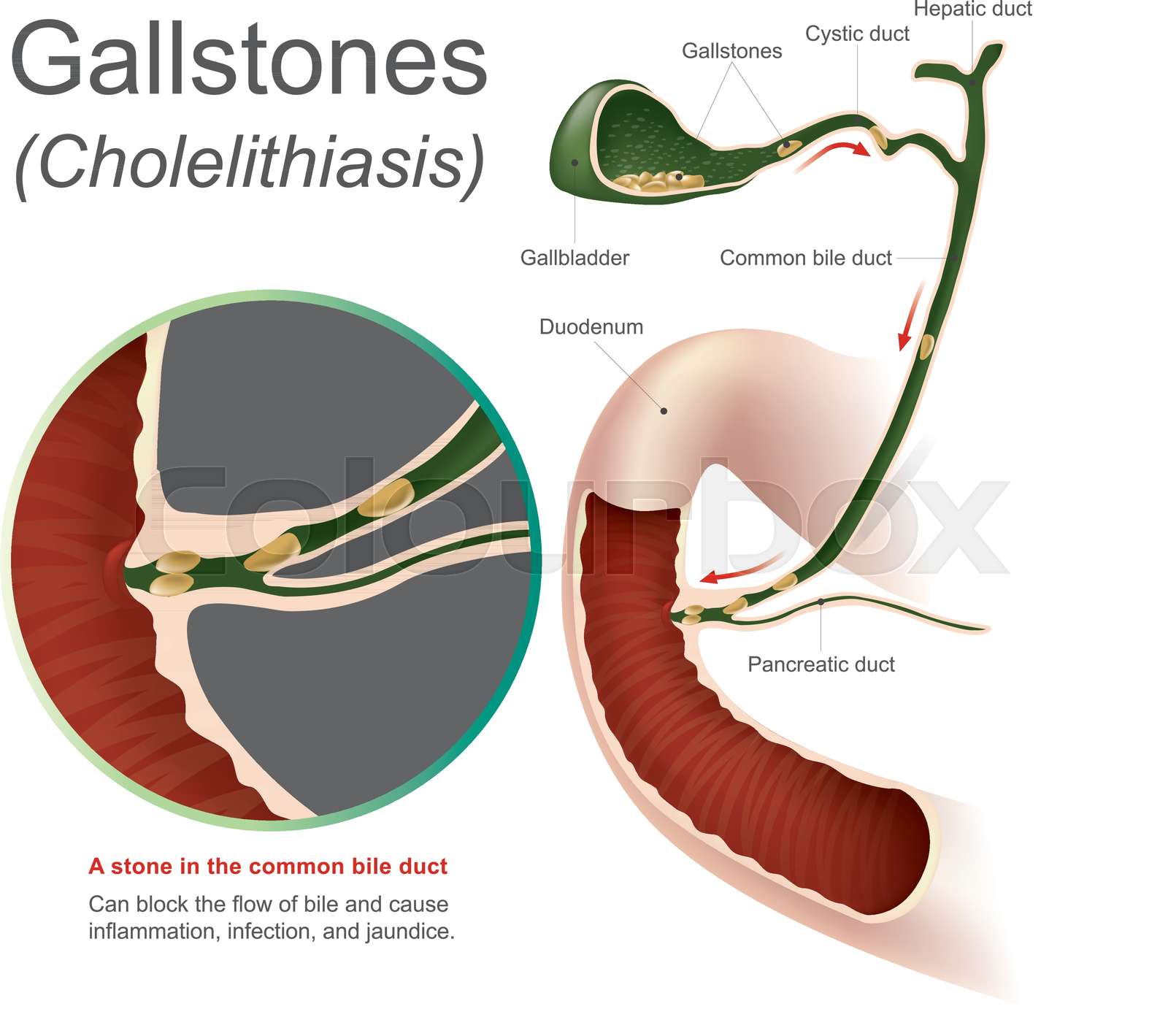 Gallstones cholelithiasis Stock vector Colourbox