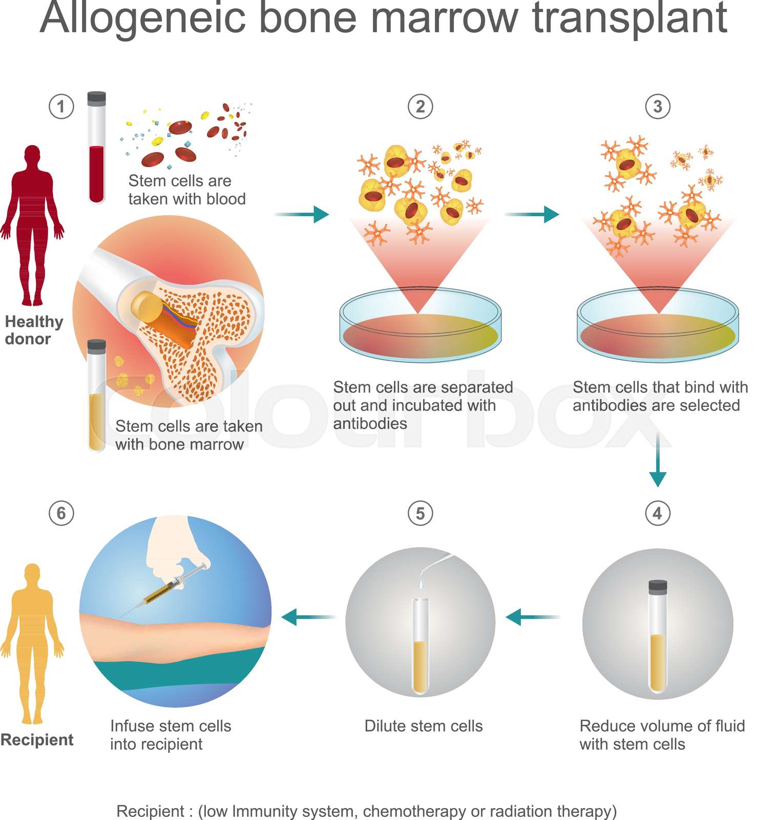 The allogeneic transplant process. Stock vector Colourbox
