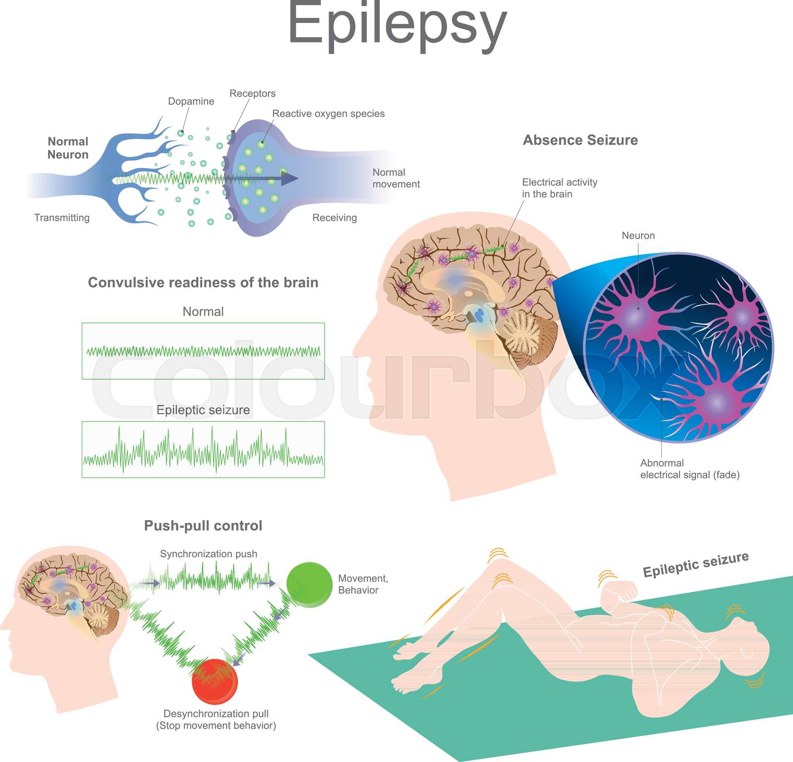 Epilepsy โรคลมชัก | Stock vector | Colourbox