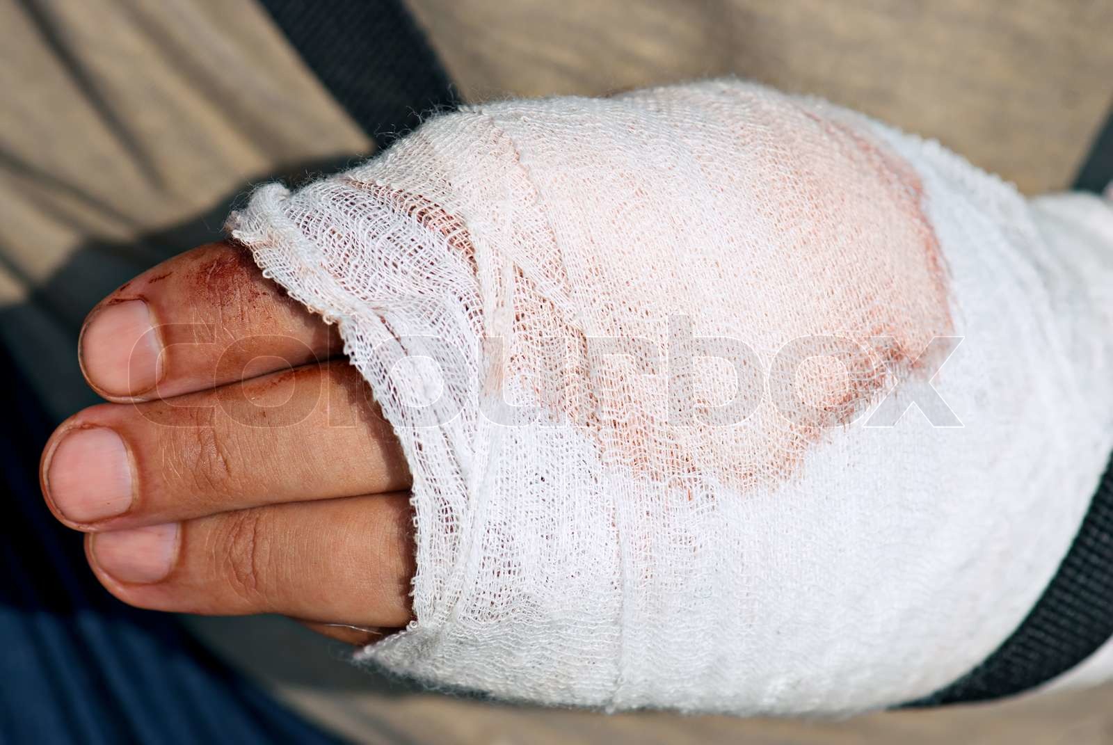 Medicin forbinding på menneskers skade hånd efter ulykke med motorsav ...