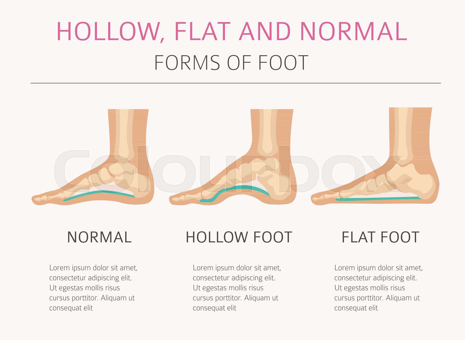 Foot deformation types, medical desease infographic. Hollow, flat and