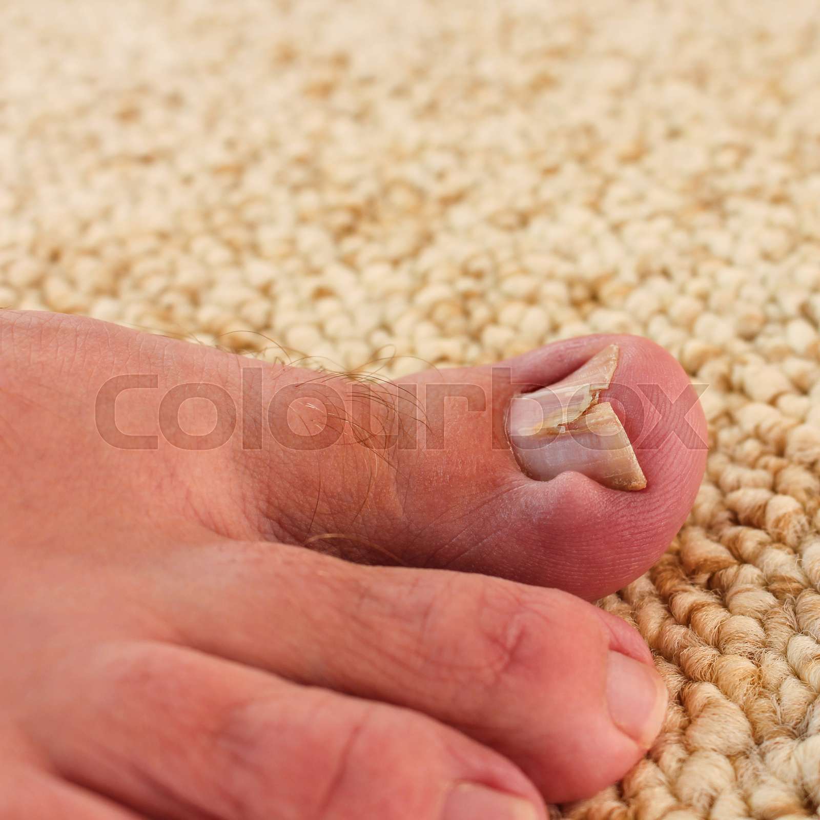 Damaged Toenail Stock Image Colourbox
