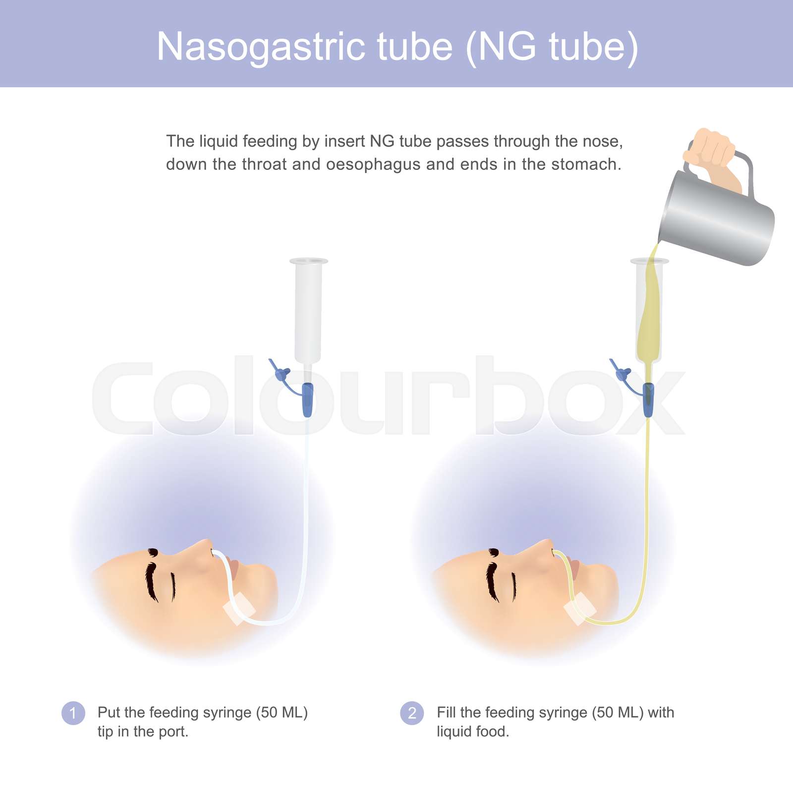 Nasoesophageal Nasogastric Tube Placement Clinician's Brief, 44 OFF