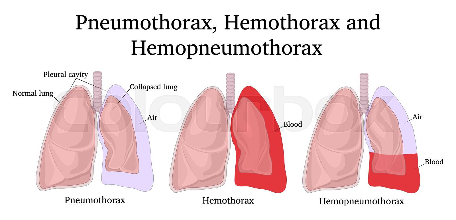 Illustration Of Pneumothorax Hemothorax And Hemopneumothorax Stock 