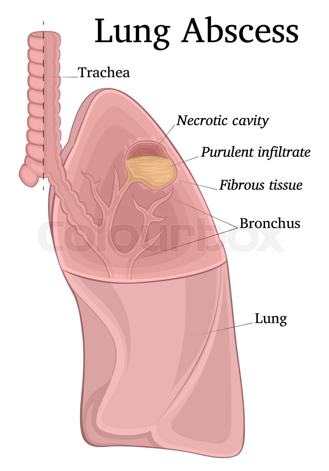 erkrankung, lungen, lunge StockVektor Colourbox