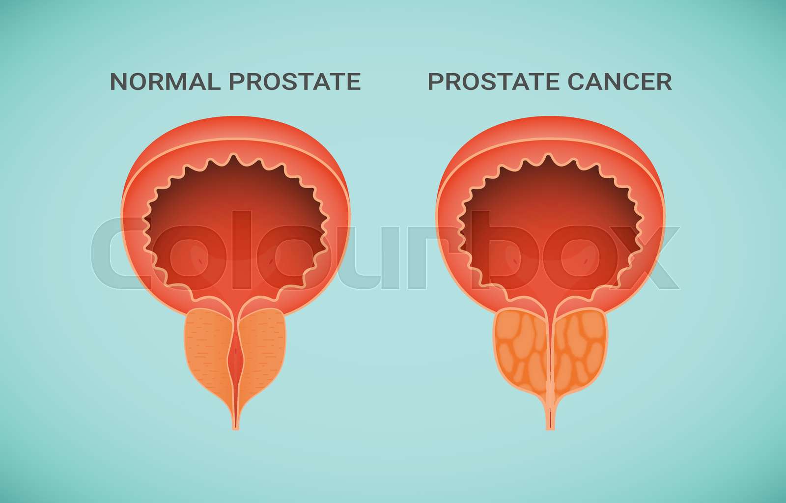 Comparison of Healthy and Cancer Prostate illustration | Stock vector