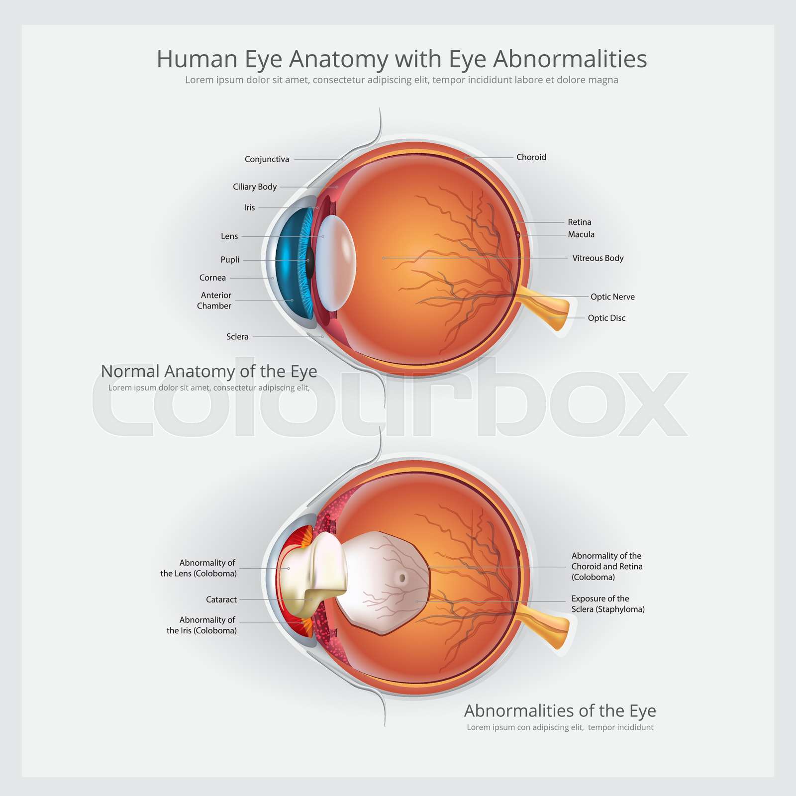 Eye Anatomy with Eye Abnormalities Vector Illustration | Stock vector ...