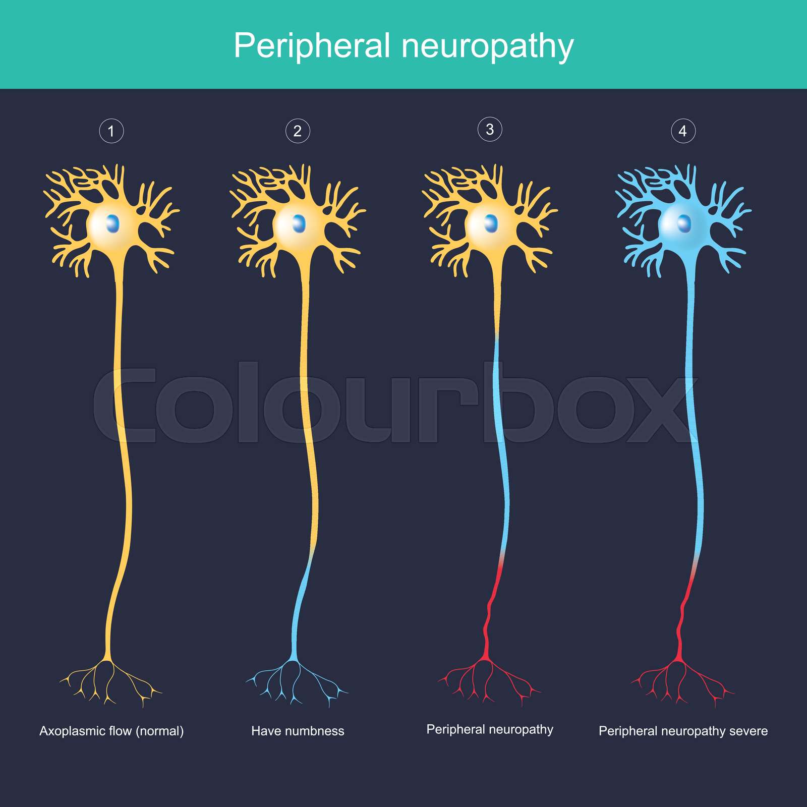 Peripheral neuropathy. Explain illustration for The Peripheral