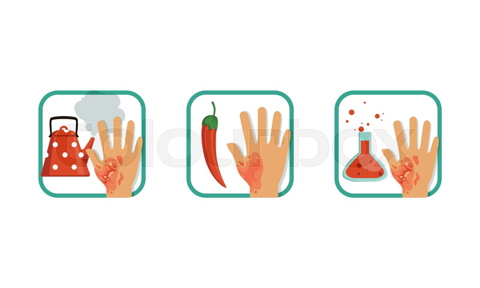 Types of Burns Set, Thermal, Chemical, Hot Chili Pepper Burns, Brochure