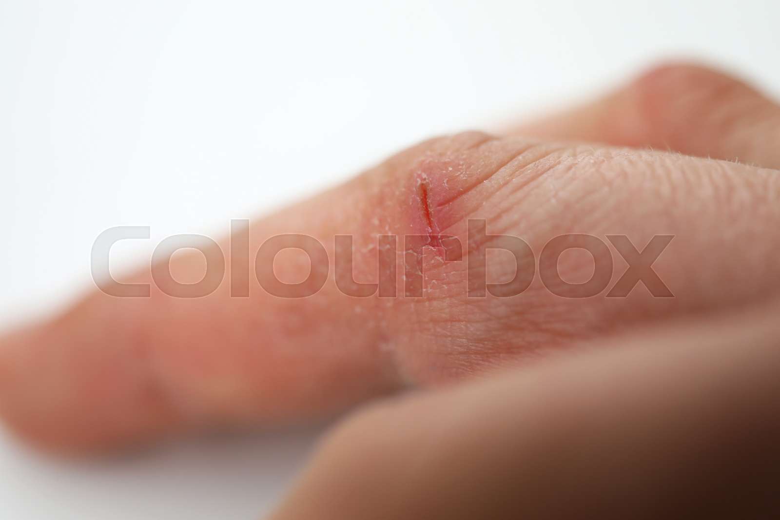 Circular Wound On Finger