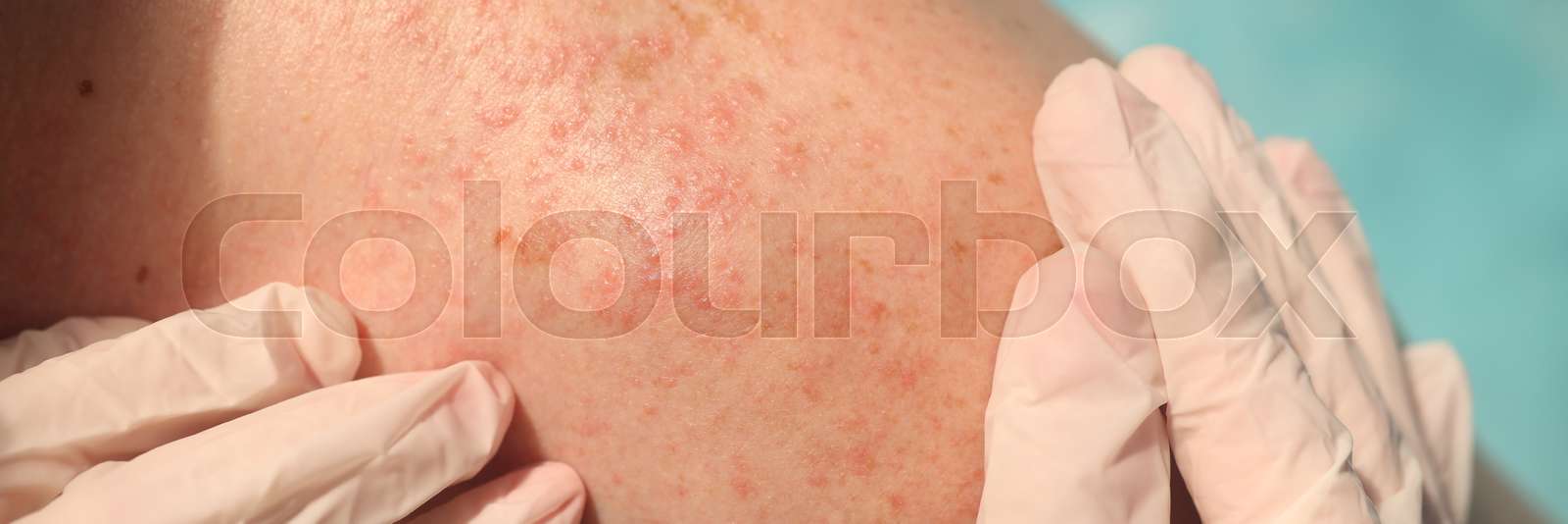 Doctor in rubber gloves examining skin of patient with red rash in