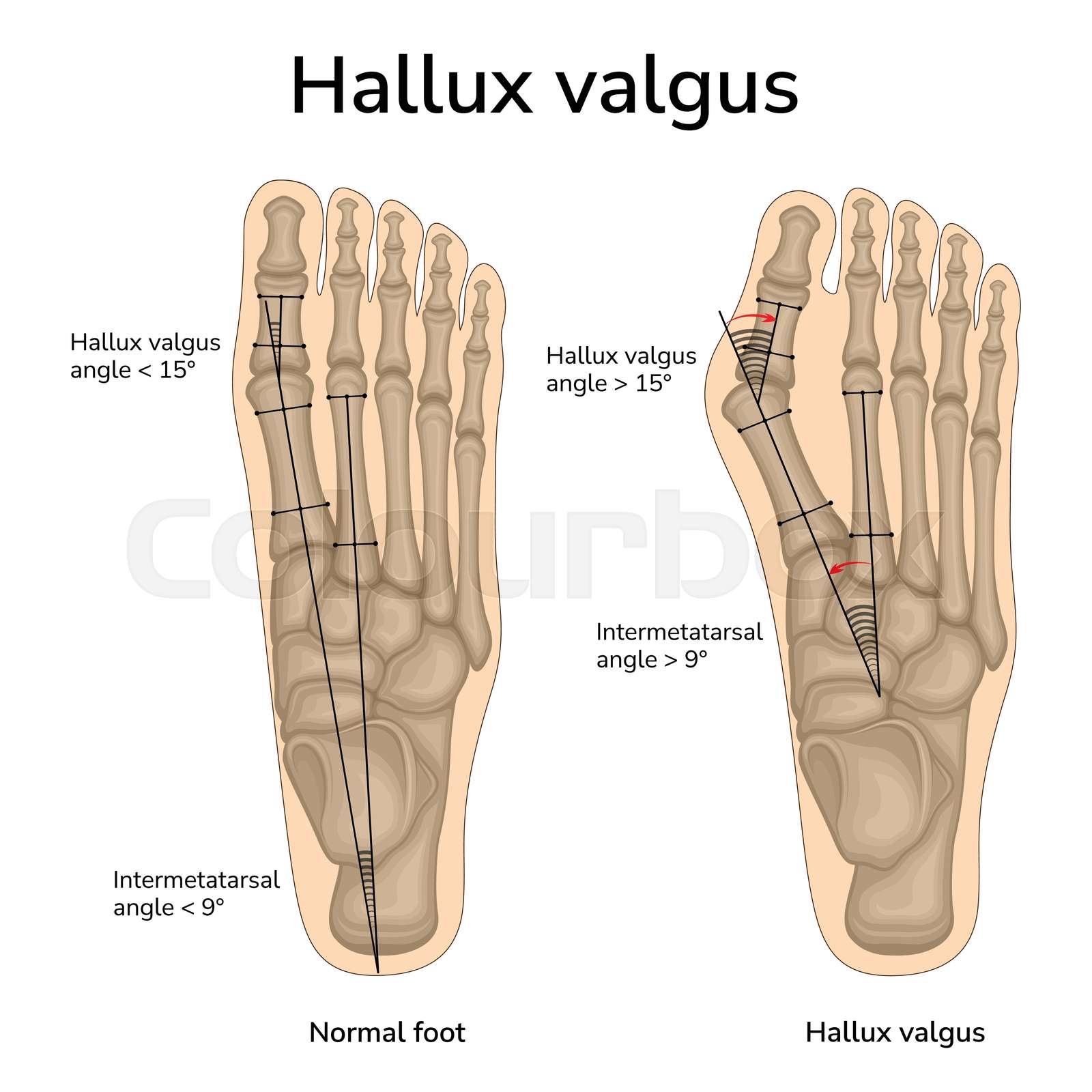 Hallux Valgus Angle hallux-valgus-angle