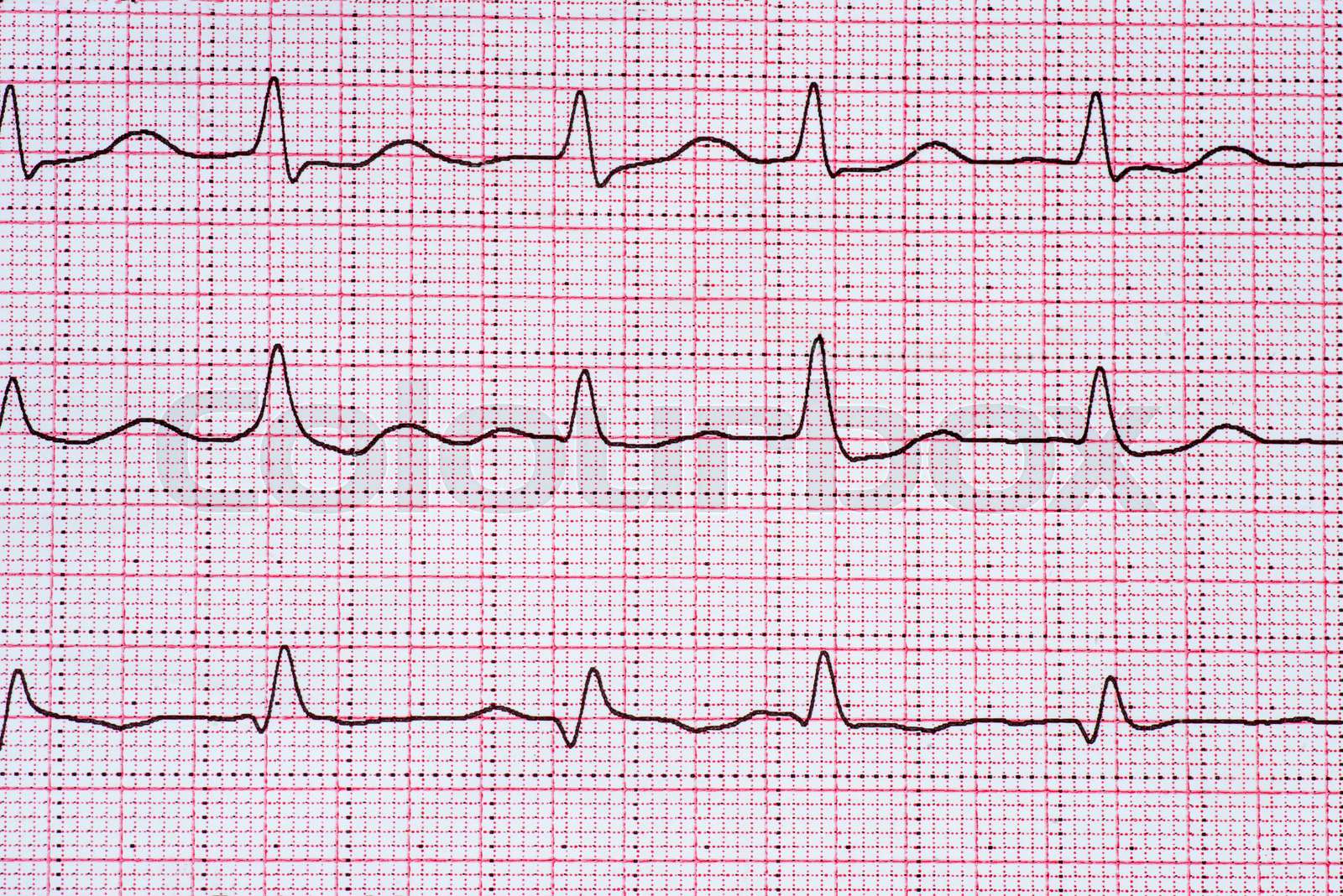 Abnormal Heart Rhythm Meaning In Hindi