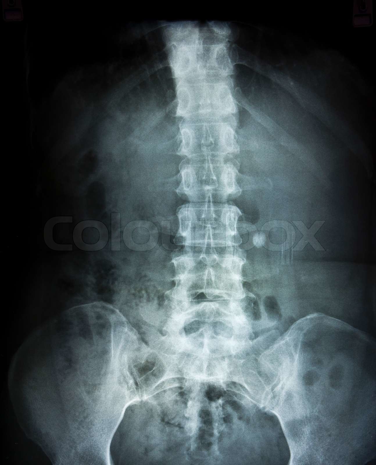 "x-ray film" | Stock image | Colourbox
