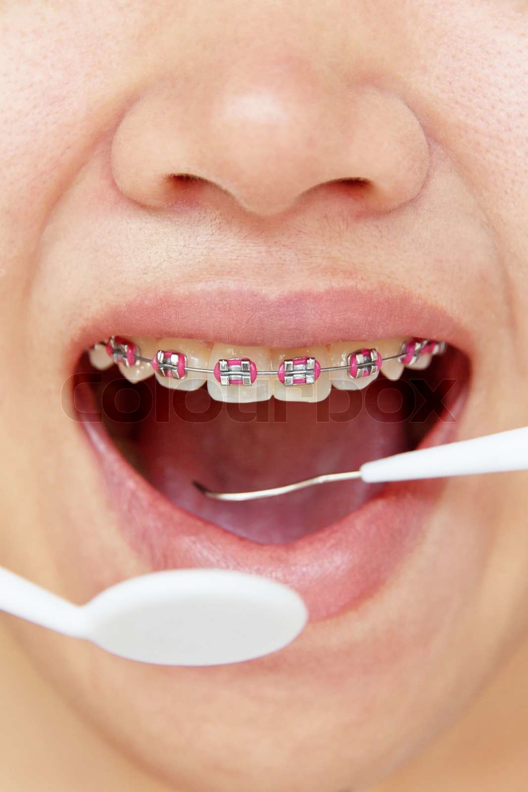 orthodontics,dental concept Stock image Colourbox