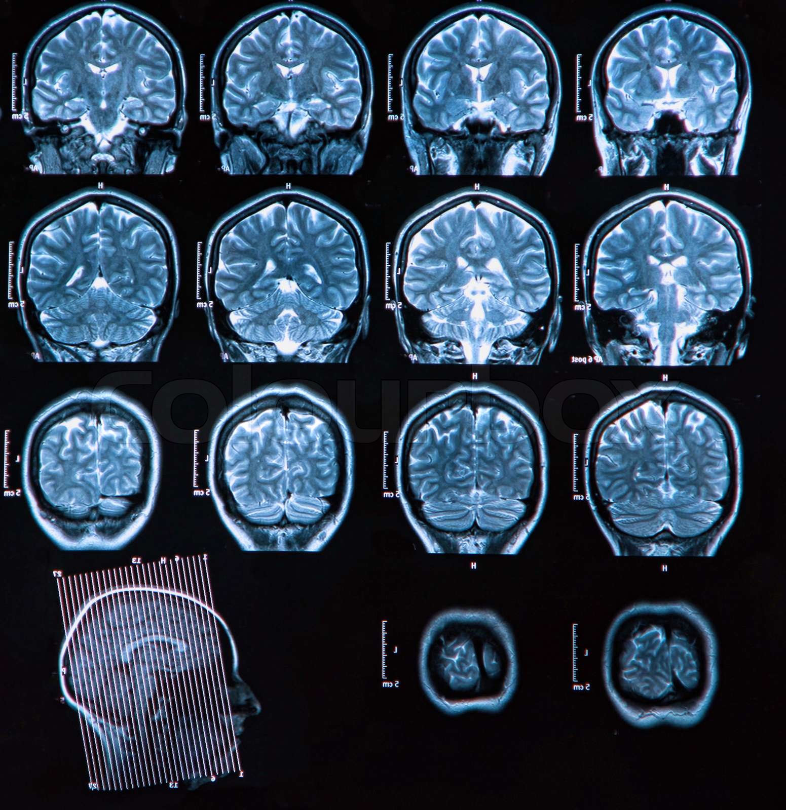 mri-hjernescanning-stock-foto-colourbox