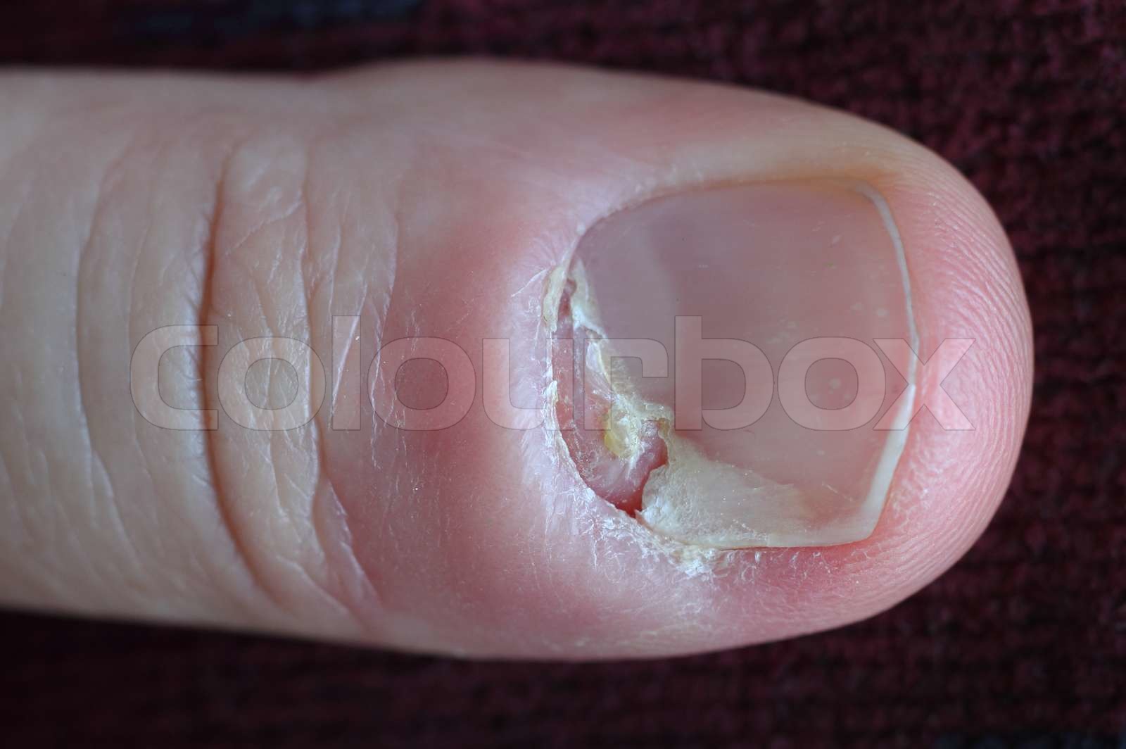 Sick nail | Stock image | Colourbox