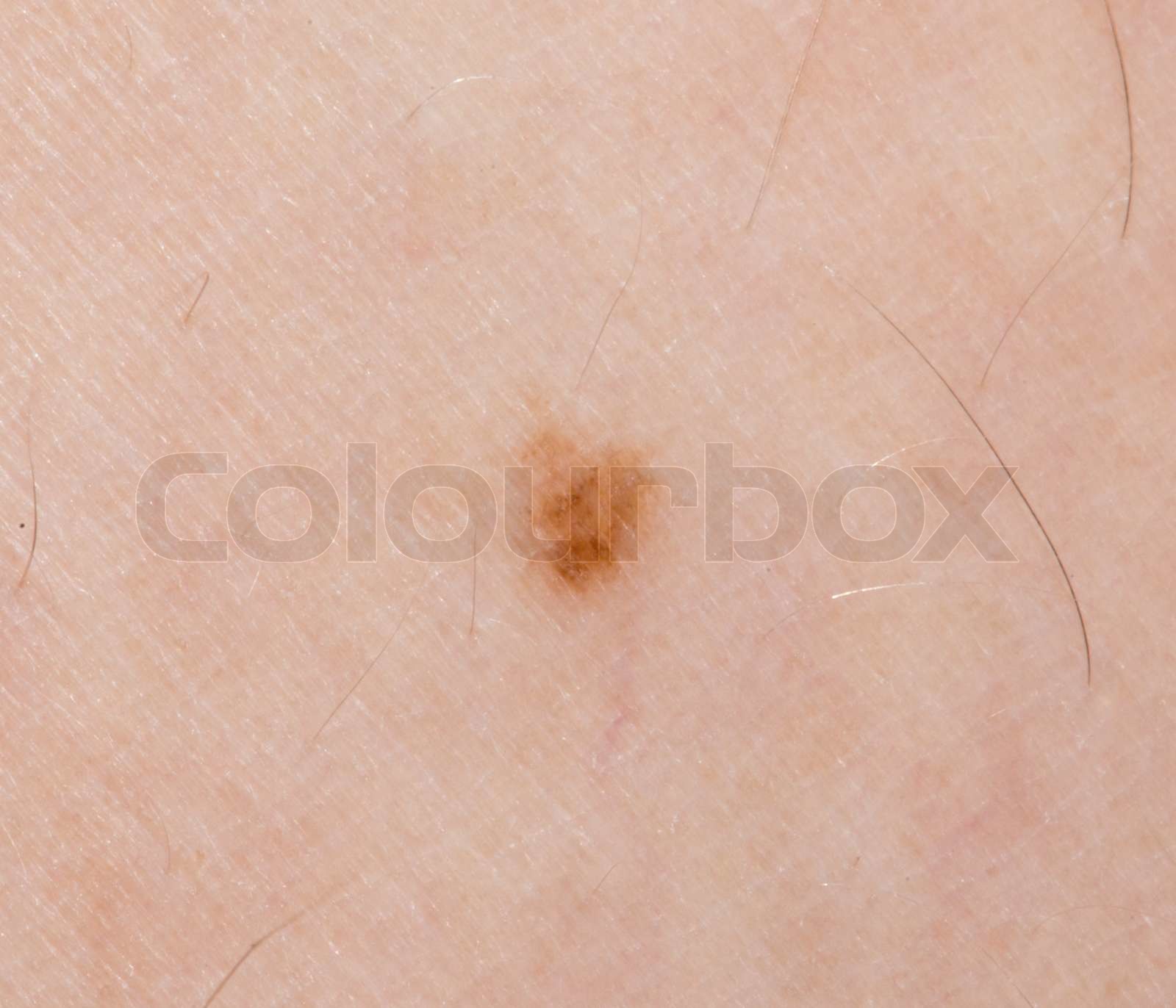 mole on the skin. macro | Stock image | Colourbox