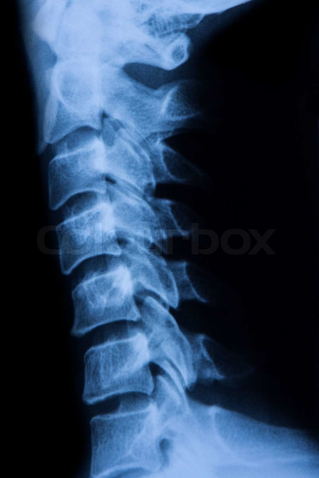 Spine X Ray | Stock image | Colourbox