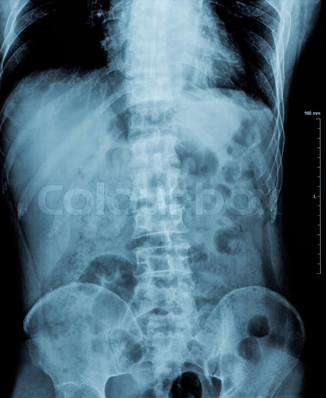 Röntgenbild Anomalien menschlichen Wirbelsäule ständig mit Becken ...