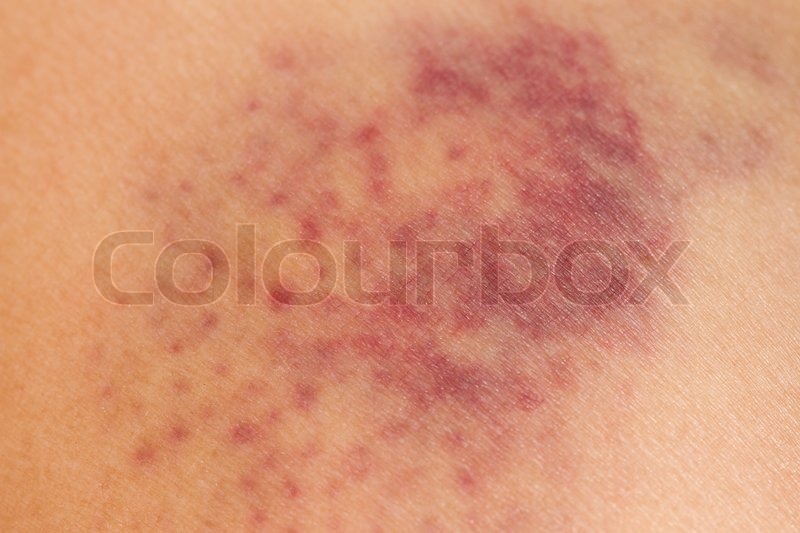 Closeup Bluterguss auf Verwundete Frau Stock Bild Colourbox