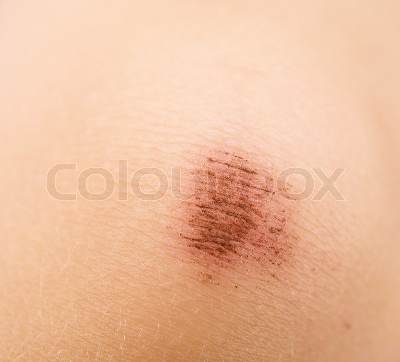 Close up of scraped knee Stock image Colourbox