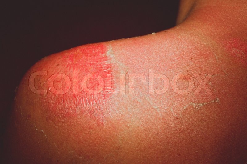 Sunburn Skin Peeling Treatment 15 Remedies To Help Get Rid Of Peeling
