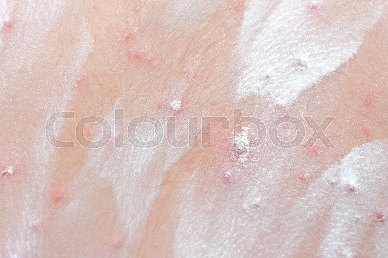 Detail baby with chicken pox rash | Stock image | Colourbox