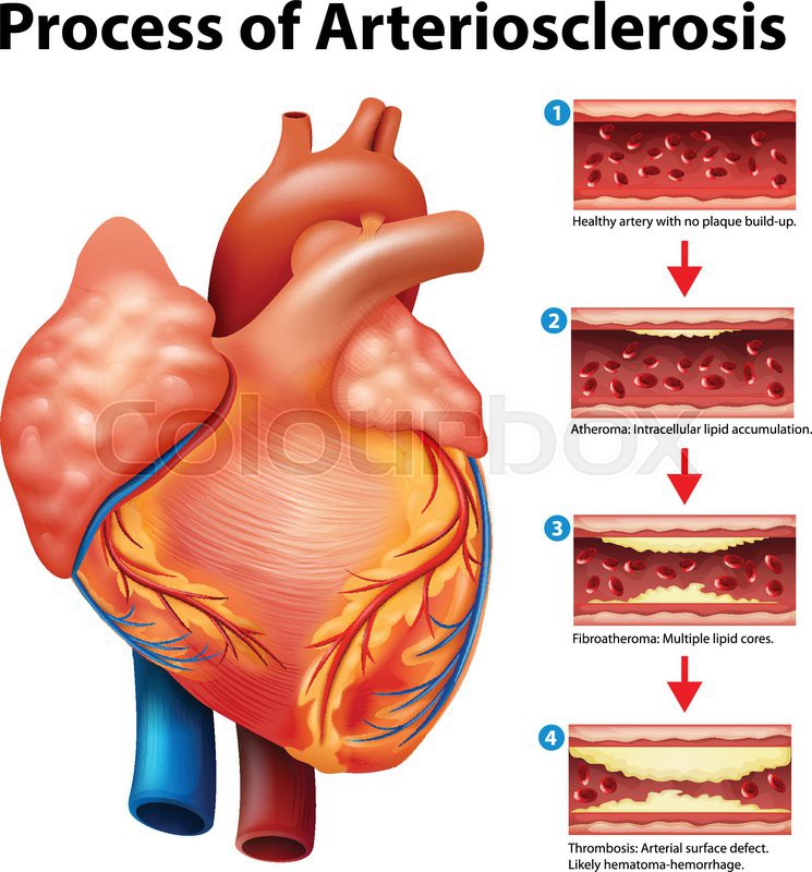 Process of Arteriosclerosis on a white background Vector Colourbox