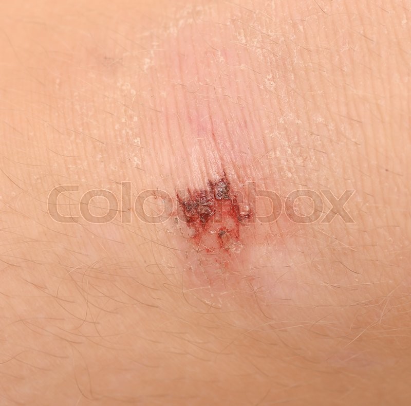 Scraped Knee Infection