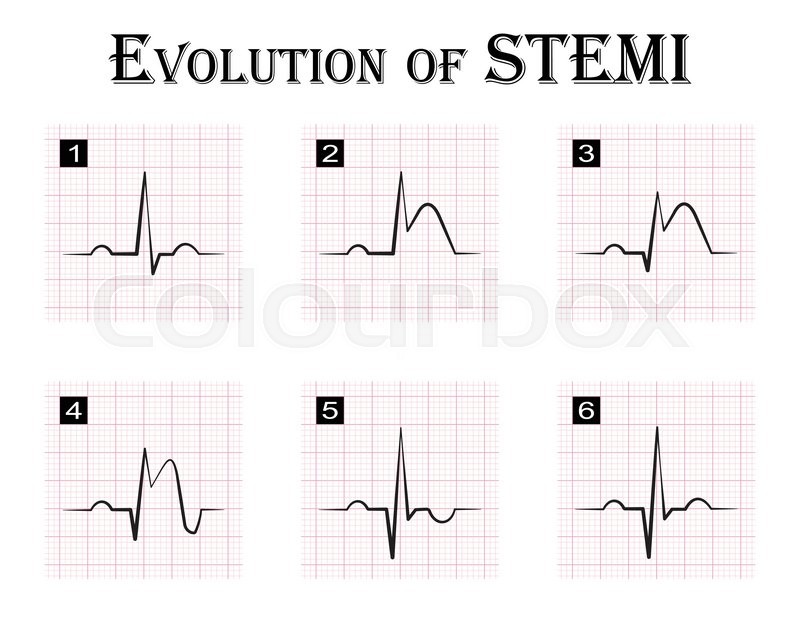 ecg of evolution step by step of stock vector colourbox st elevation myocardial infarction