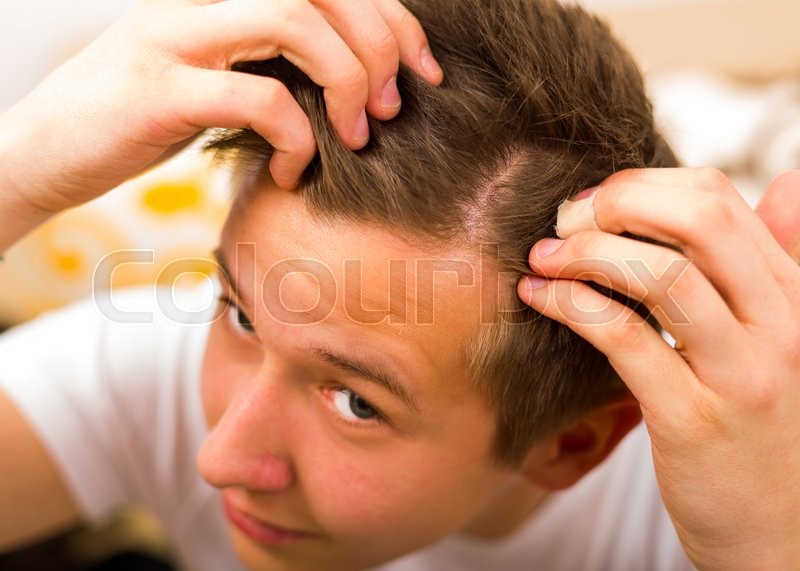 Young Man Having Periodical Hair Loss Stock Image Colourbox