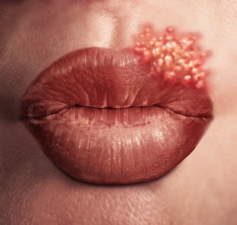 Cold sore herpes virus medical health ... | Stock image ...