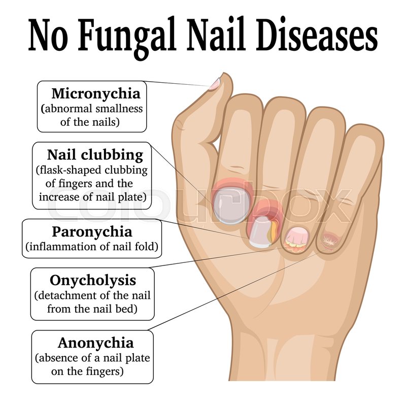 illustration of five different non stock vector nail disorders chart