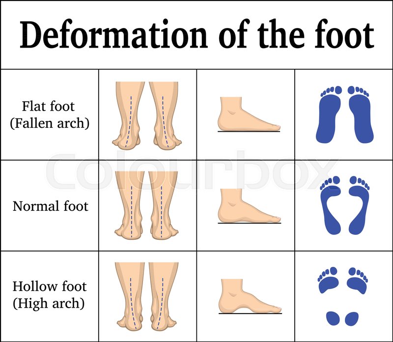 supination and flat feet